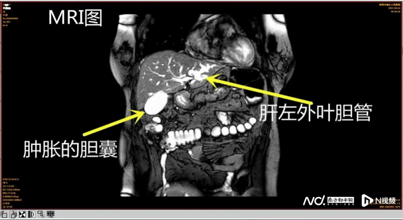 困扰多年的肝内外胆管结石终于摆脱了，她给医院送了封手写信