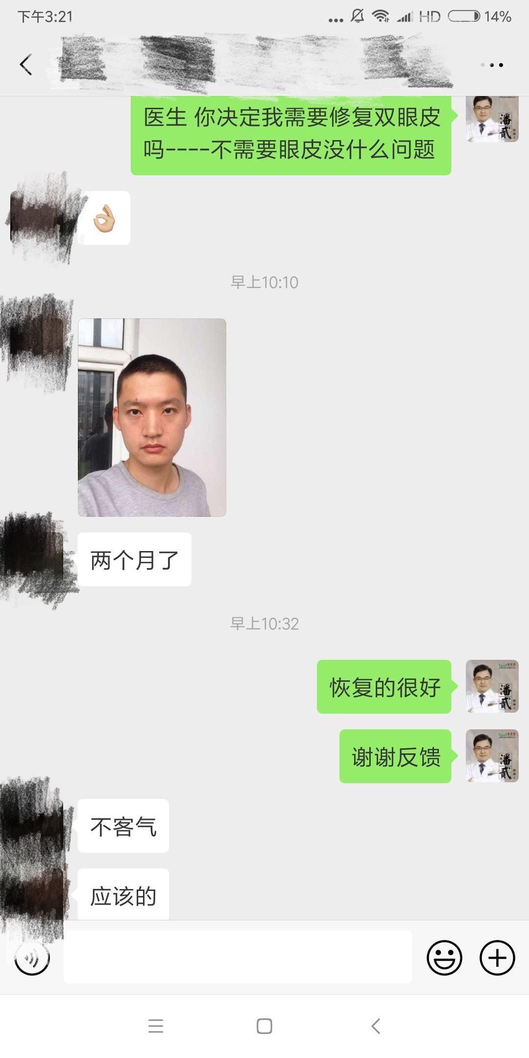 开眼角前后对比照片 开眼角失败的八种图片